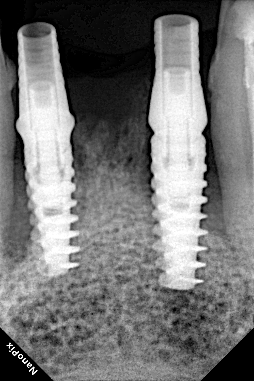 Dental implant after treatment