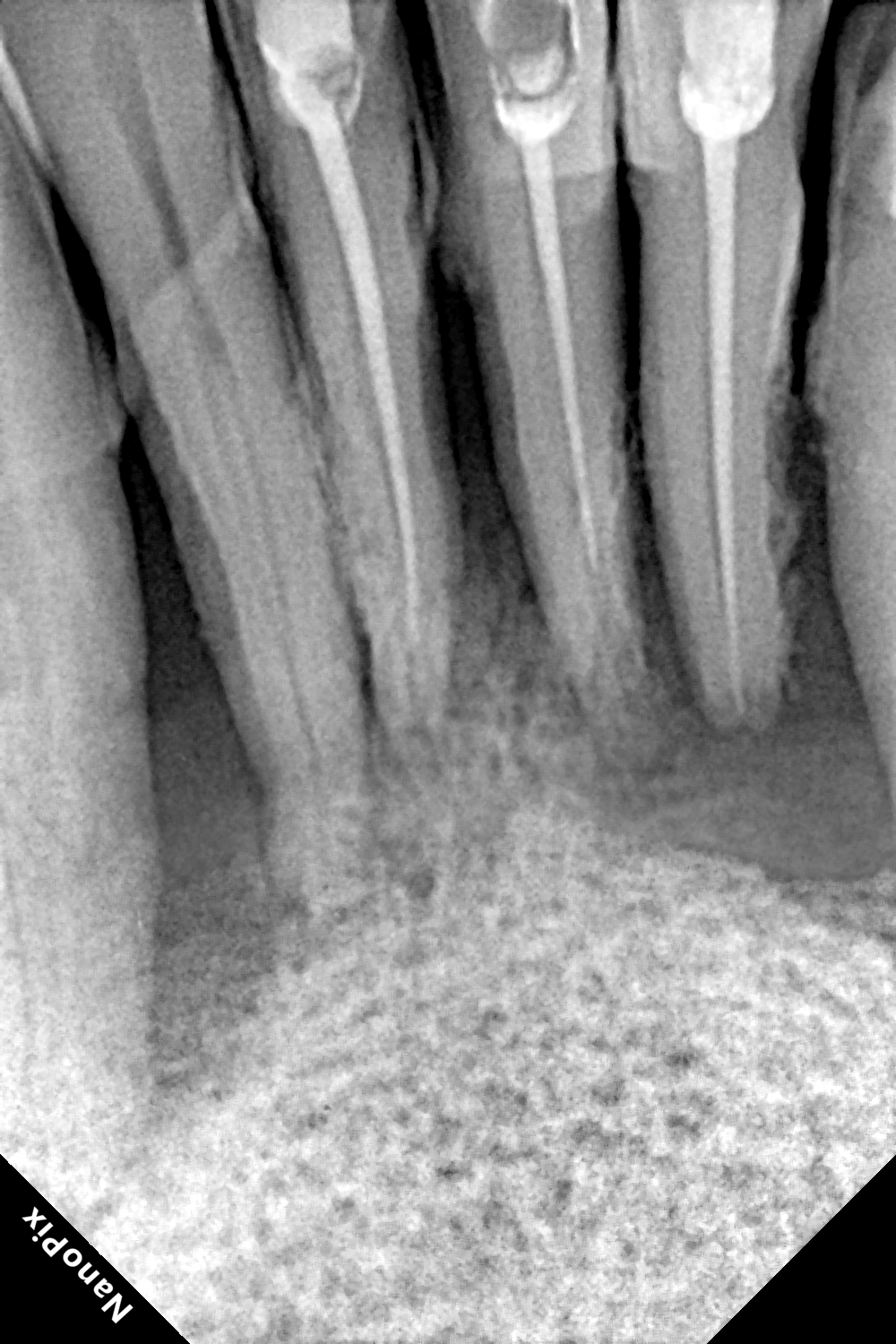 Dental implant before treatment